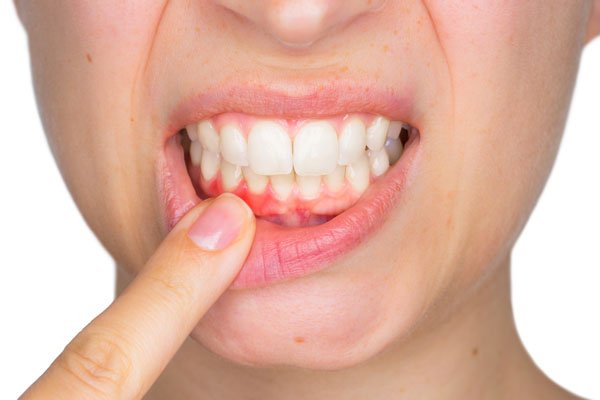 Sưng nướu răng sẽ gây chảy máu chân răng nếu có tác động ngoại lực