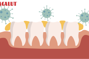 Cao răng là gì? Nguyên nhân, triệu chứng và cách phòng ngừa