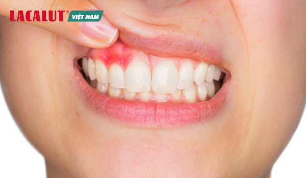 viêm nướu là tình trạng viêm phần mềm xung quanh chân răng