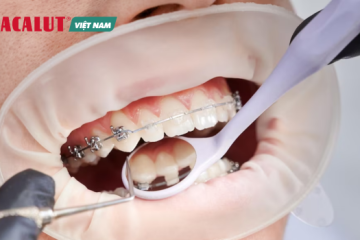 Viêm nướu niềng răng – Cách nhận biết và khắc phục