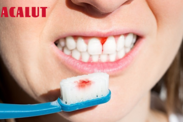 Đánh răng bị chảy máu là bệnh gì? Cách điều trị